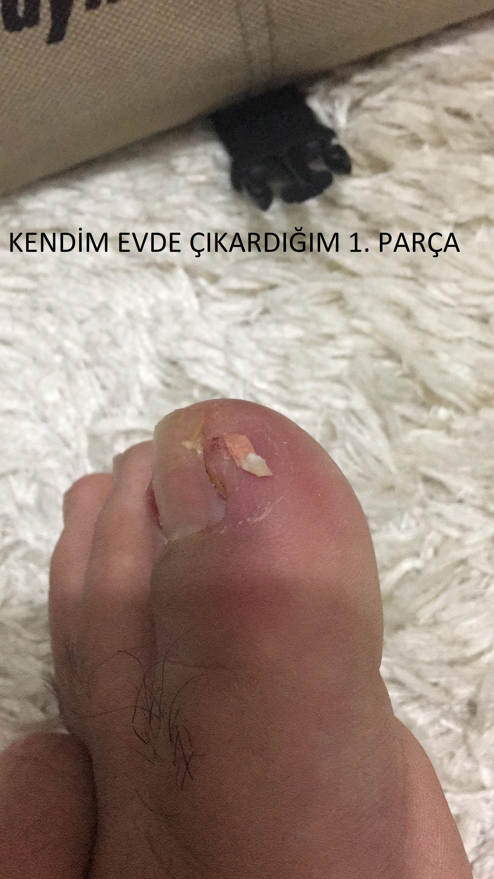 Tırnak batması ( soru ve cevapları ) Tırnak batması ( soru ve cevapları )
