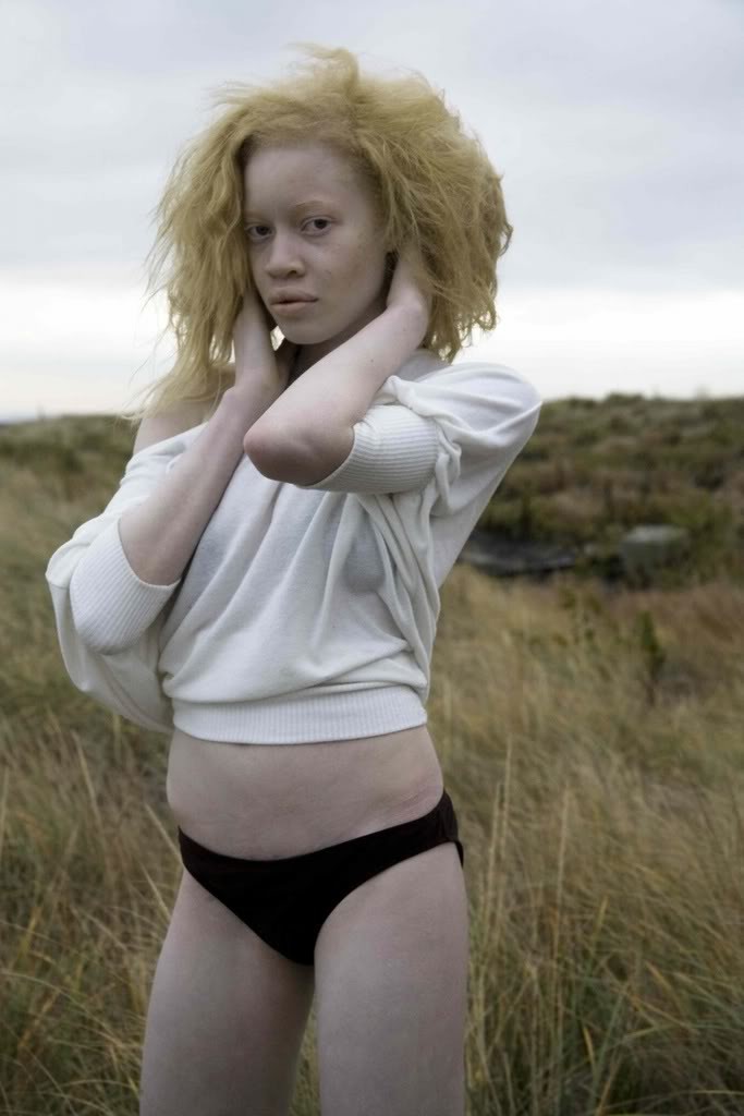 Nude Albino Pictures