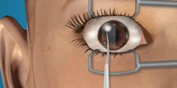 Göz Ameliyatı