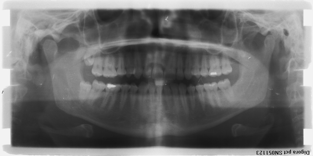  20 lik diş ameliyatım hakkında