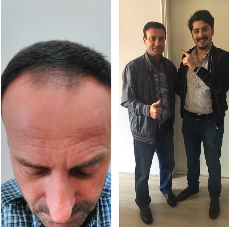  en iyi saç ekim merkezi neresidir