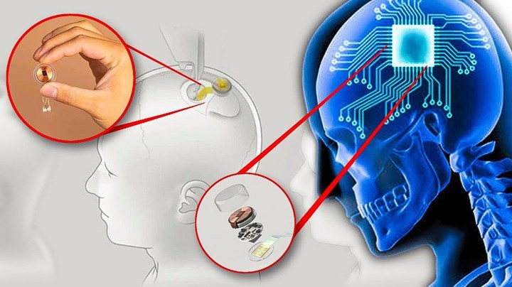 Elon Musk'ın Neuralink şirketi üçüncü hastanın beynine çip yerleştirdi