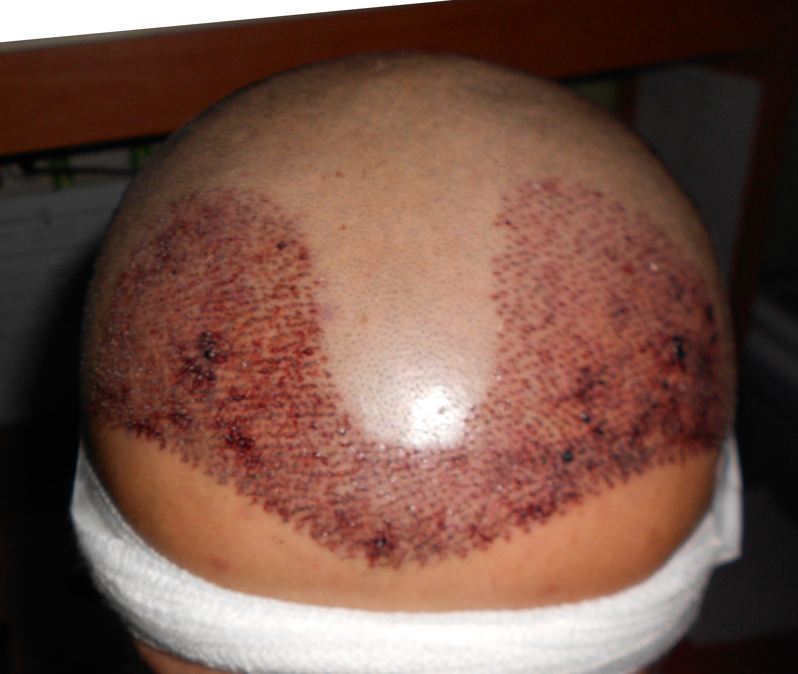  en iyi saç ekim merkezi neresidir