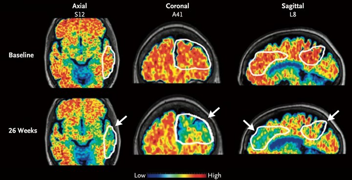 Alzheimer hastalığının insandan insana bulaştığına dair ilk kanıt bulundu