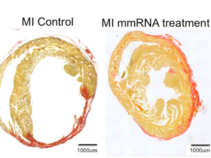 Yeni mRNA tedavisi, kalp krizi sonrası kalbi iyileştirebilir
