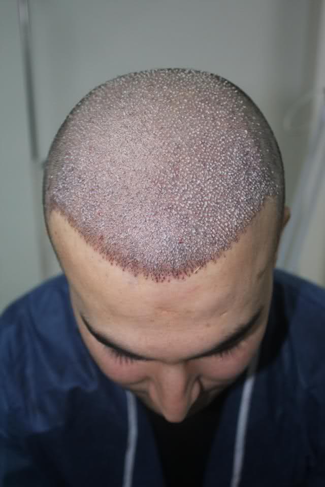 Пересадка волос красноярск