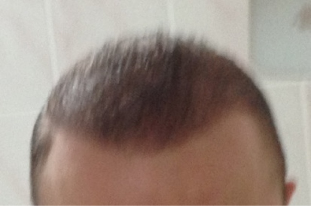  en iyi saç ekim merkezi neresidir