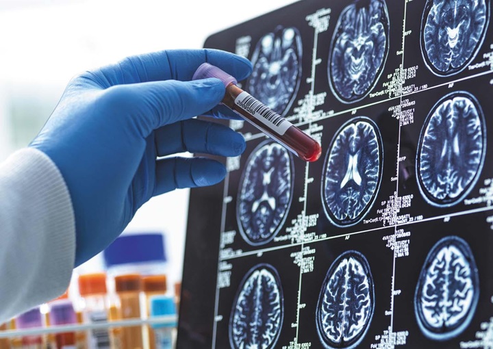 Basit bir kan testiyle Alzheimer'ı erkenden teşhis etmek mümkün olabilir