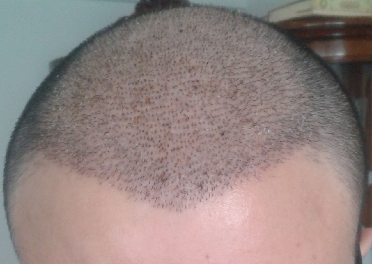  en iyi saç ekim merkezi neresidir