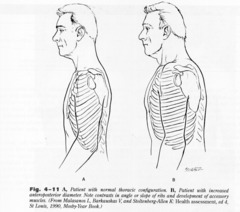  Fıçı Göğüs / Barrel Chest