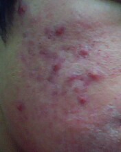 Roaccutane - Zoretanin Hakkında Herşey! Roaccutane - Zoretanin Hakkında Herşey!