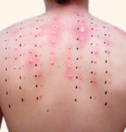 Nazal sürüntü örnekleri alerji testlerinin yerini alabilir