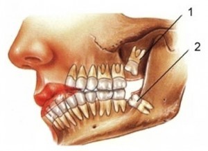 20lik diş diğer dişlerimi parçalamaya başladı acı muazzam. bi kaç sorum var lütfen bakın