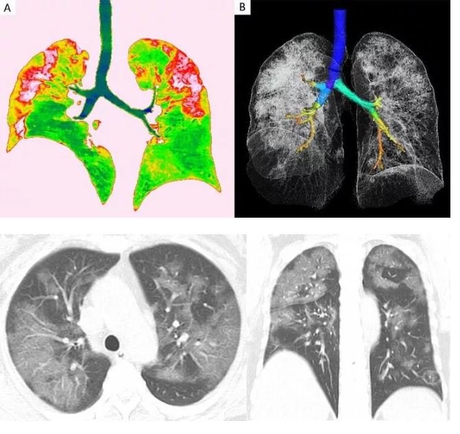 Koronavirüsün akciğerlere verdiği zararı gösteren röntgen ve tomografi görüntüleri ortaya çıktı